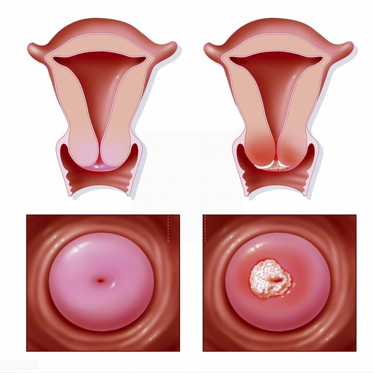 宫颈癌——有望成为被消灭的第一个癌症