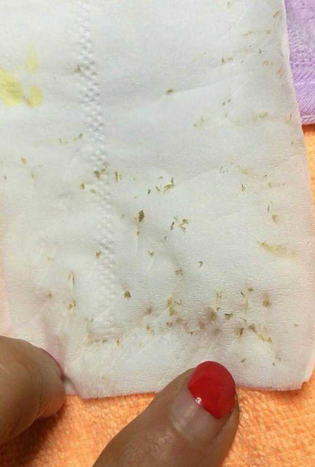 鼻子上挤出来的白色东西如何去除,鼻子上挤出来的白色分泌物是什么