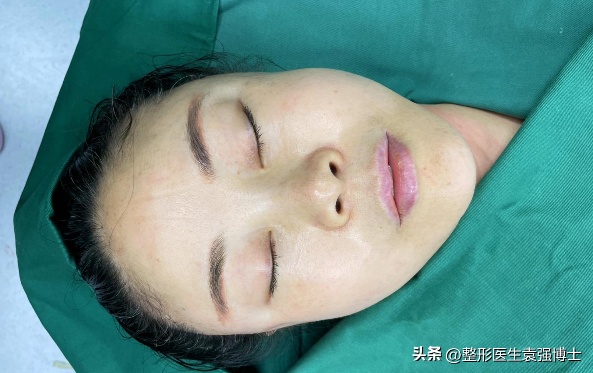 大拉皮前后效果,拉皮前后效果自然吗