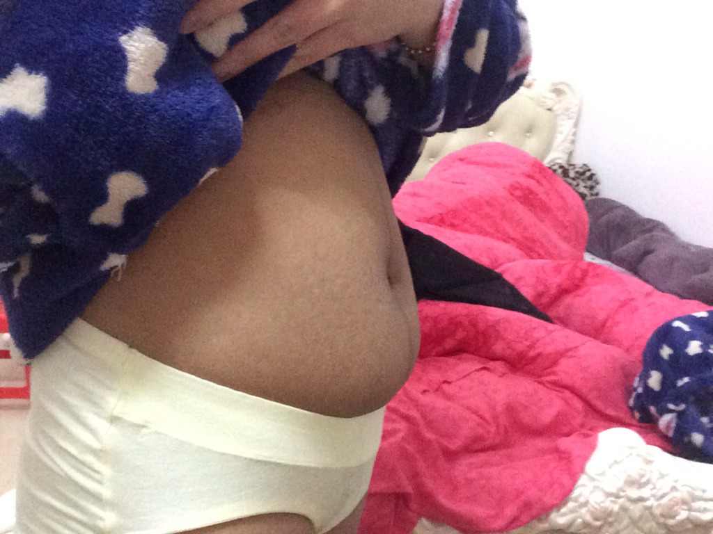 生产后肚子上皮肤黑线怎么去除,产后妈妈肚子上那条黑线能下去吗