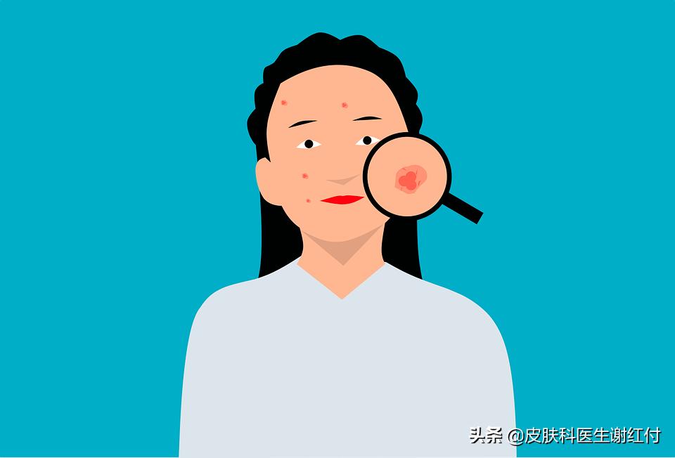 祛痘小知识如何正确避免长痘痘,5个快速祛痘方法跟痘痘说拜拜