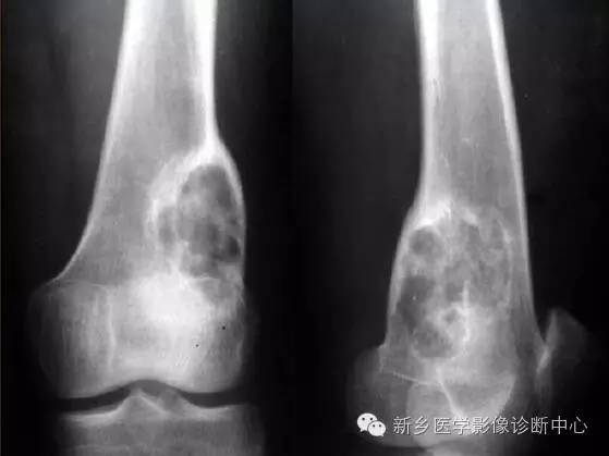 长骨膨胀性病变,长骨偏心性膨胀性病变