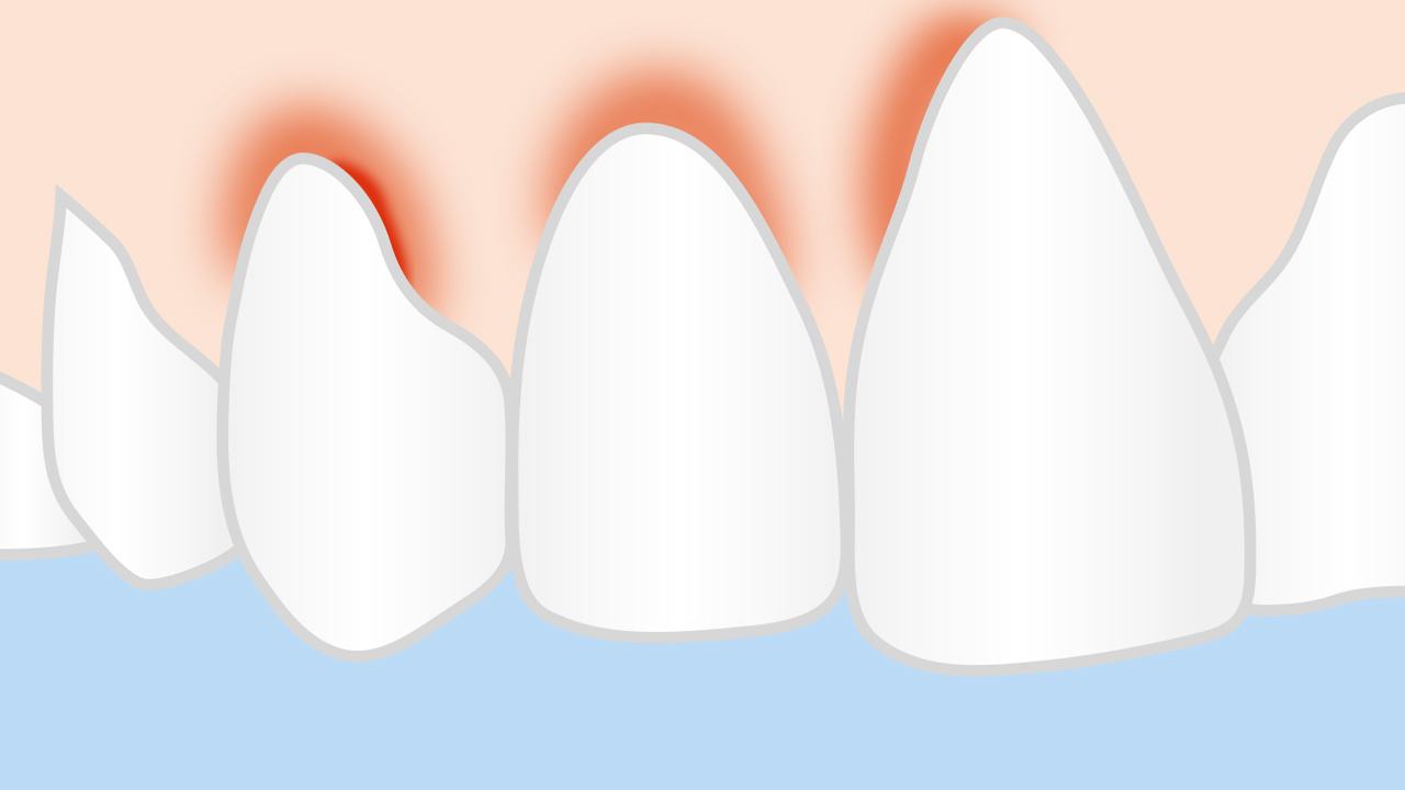 牙缝中的牙结石怎么去除,牙缝间的牙结石怎么清除