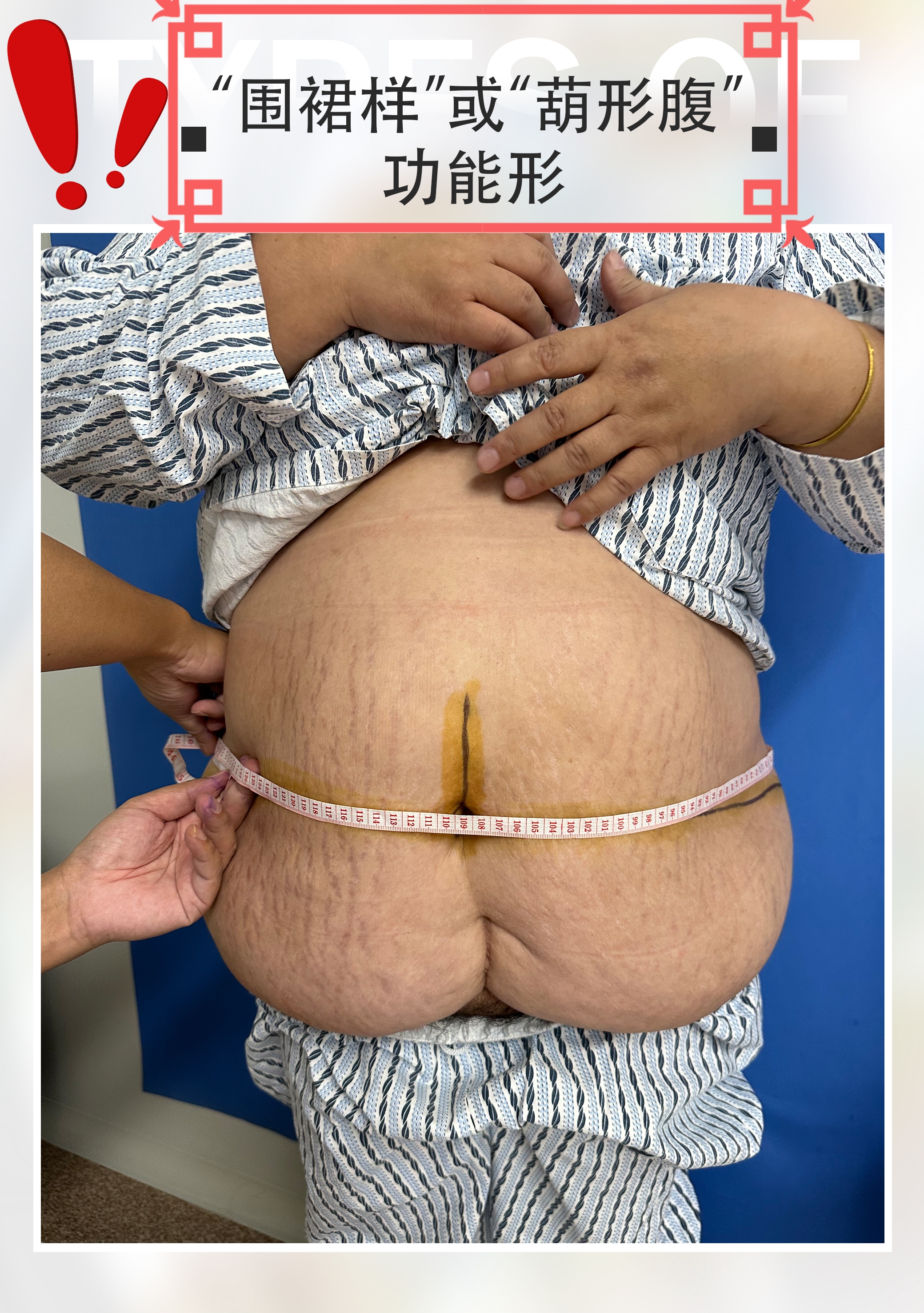 做腹壁整形后的真实案例,腹壁整形修复后的效果图