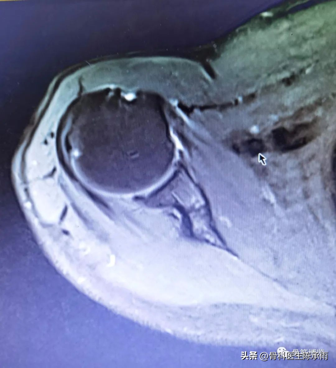 肱二头肌长头肌腱断裂超声报告,上臂肱二头肌