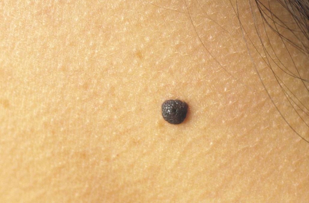 警惕这些痣可能会成瘤,哪些地方有痣代表得癌症了