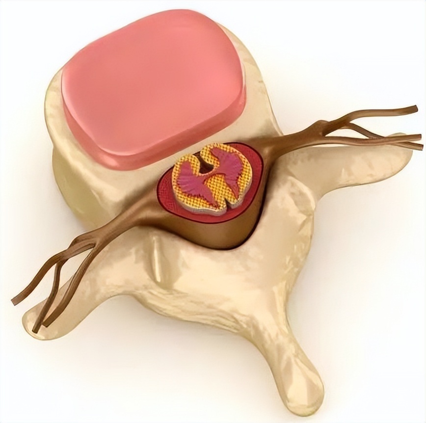 胸椎小关节紊乱和冠心病,胸椎小关节紊乱心脏