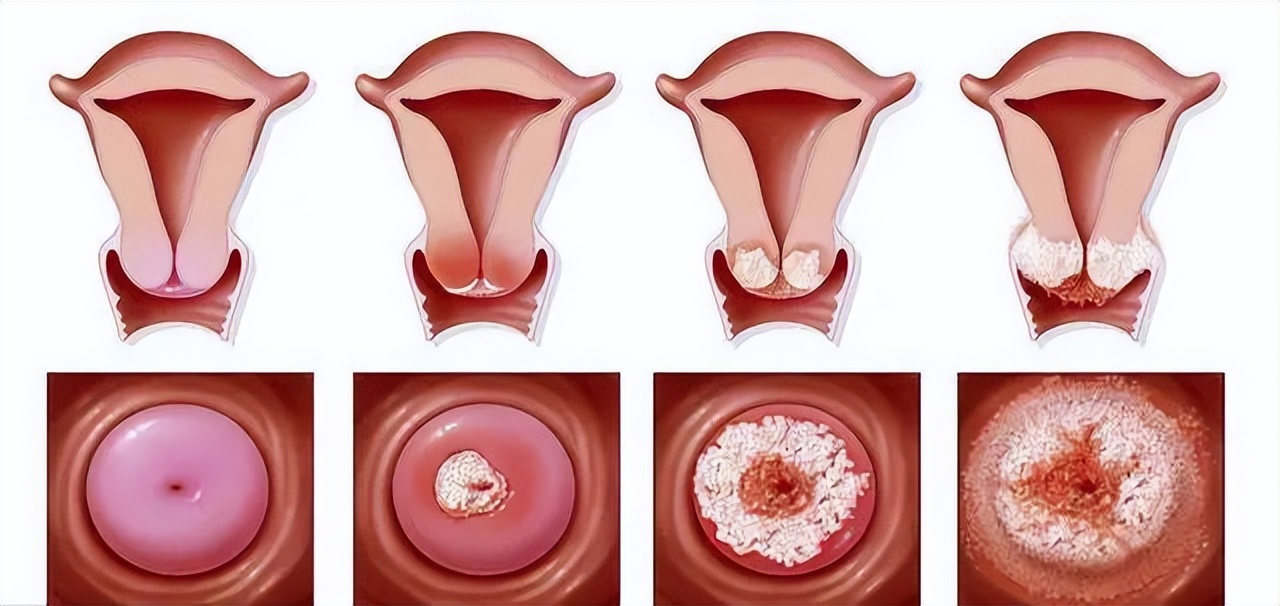 查出宫颈上皮瘤样病变怎么办？别慌，它不等于宫颈癌！