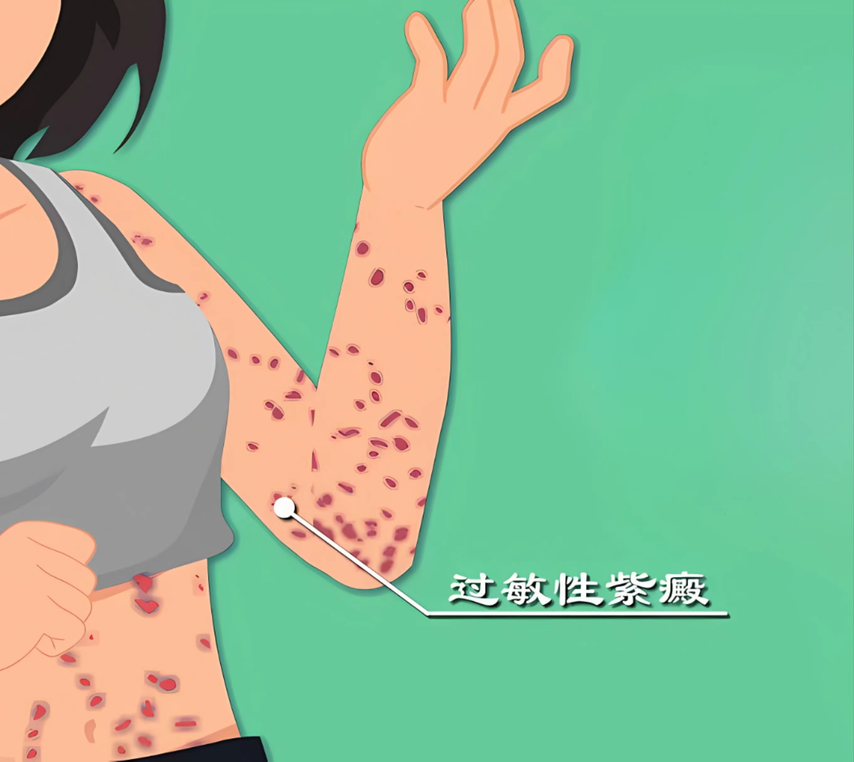 什么是过敏性紫癜肾炎,什么是过敏性紫癜能痊愈吗