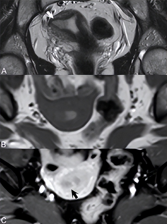 宫颈癌检查能查出子宫内膜癌吗,盆腔磁共振能看出子宫内膜癌吗