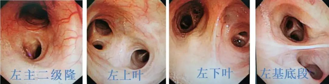 反复发烧但是拍片显示轻微肺炎,一直高烧39-40是肺炎么