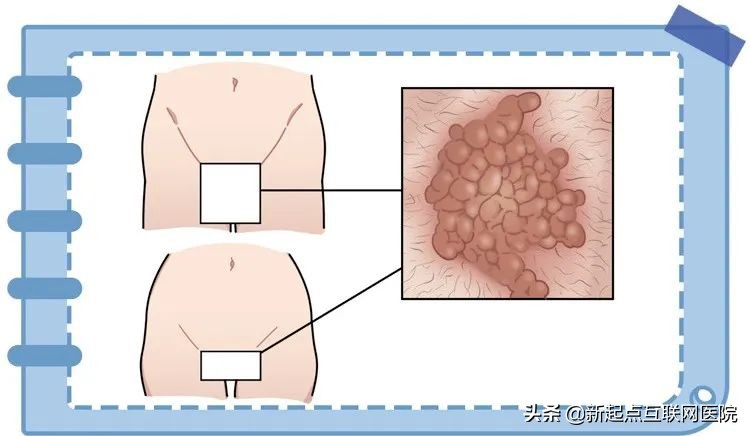 下面长了小红疙瘩,下面长红色小疙瘩很痒是什么情况