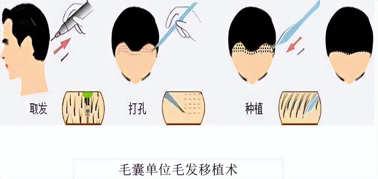 雄激素脱发用什么洗发水好,怎么确定自己是雄激素脱发