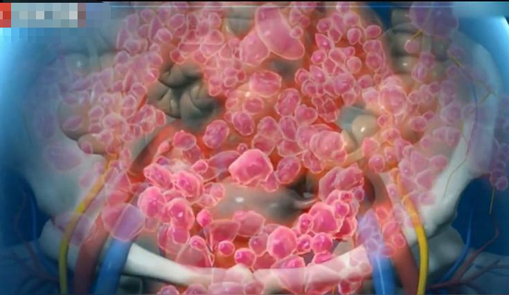 女孩体内4000多肿瘤,女孩体内上千肿瘤结果怎么样了