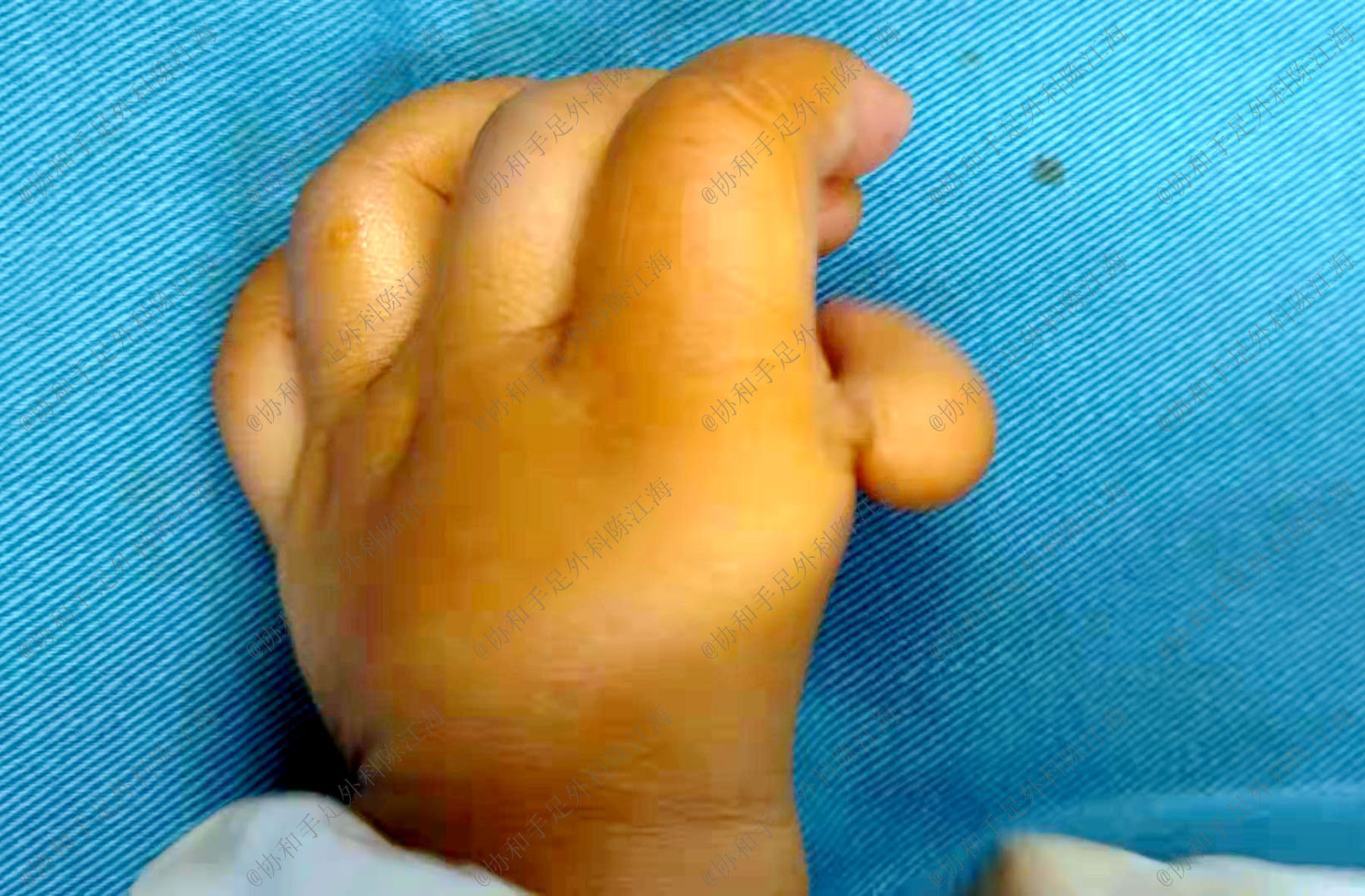 宝宝拇指不能伸直怎么回事,宝宝手部握拳没力气