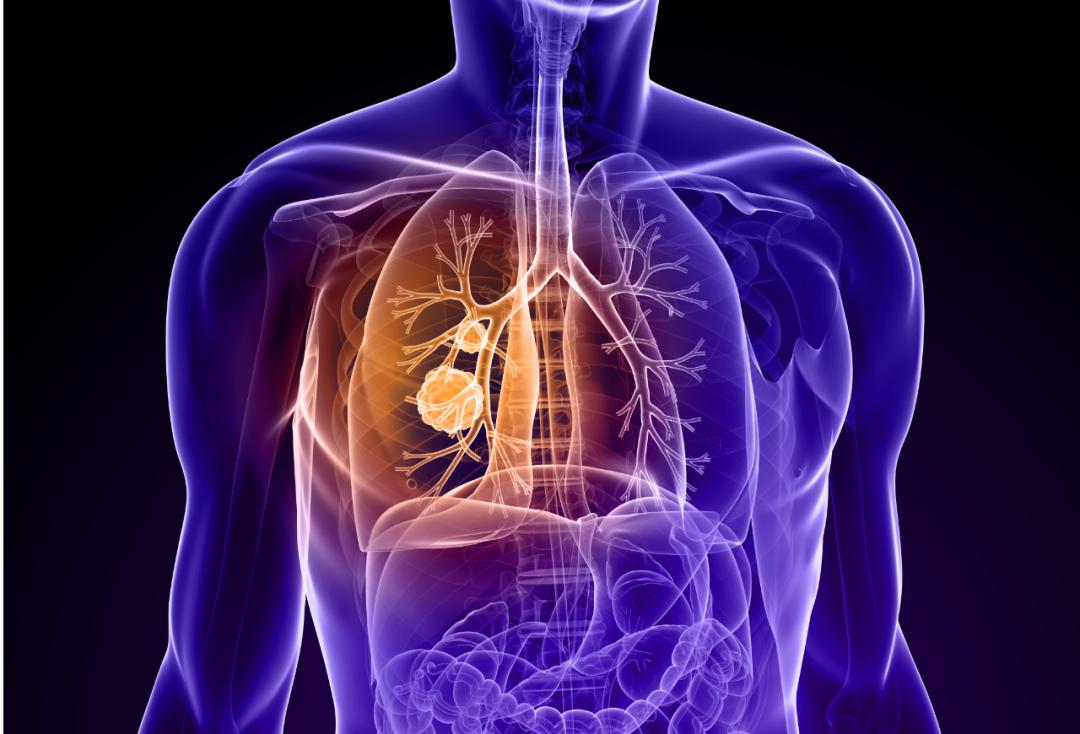 查出肺结节吃什么药好得快,查出肺结节需要停心脏病的药吗