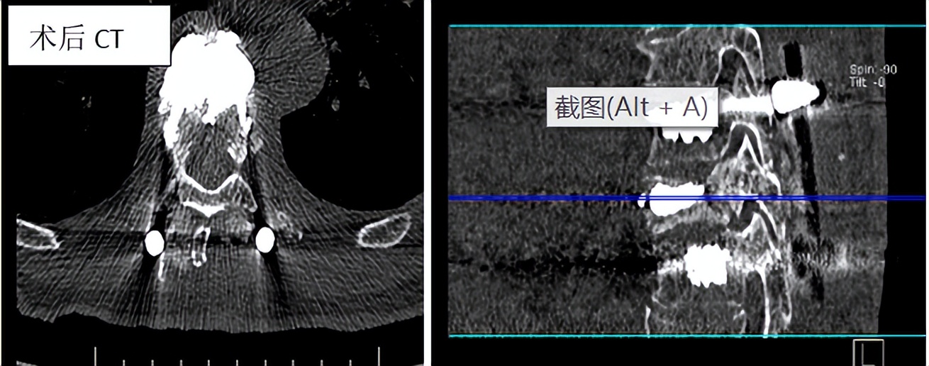 胸腰椎压缩性骨折特色治疗方法,老年人胸腰椎骨折怎么治疗