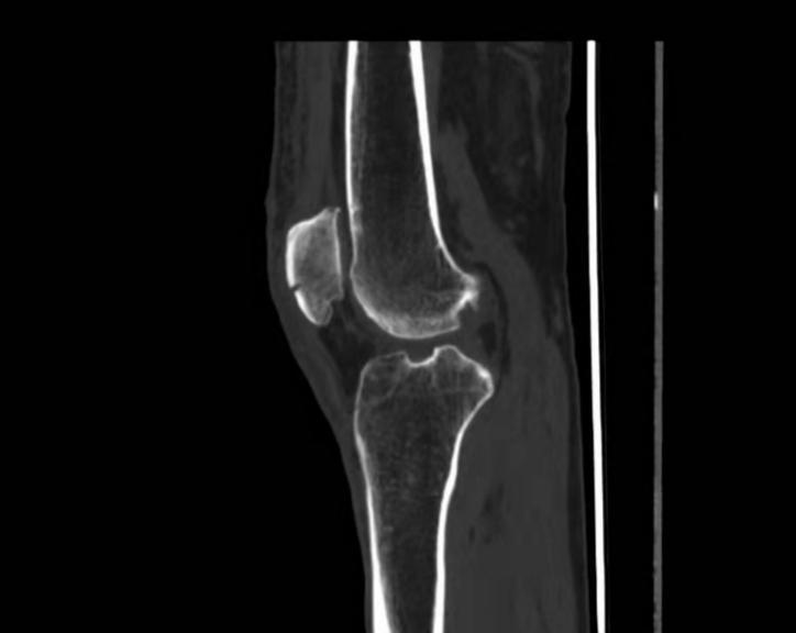 髌骨骨折70天保守治疗还不会走路,70岁老人髌骨骨折手术住院多久