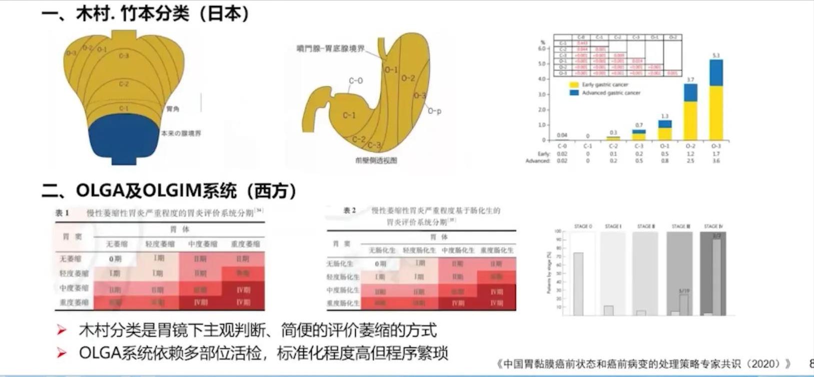 胃早癌食管早癌会复发吗,胃早癌与进展期癌怎么区分
