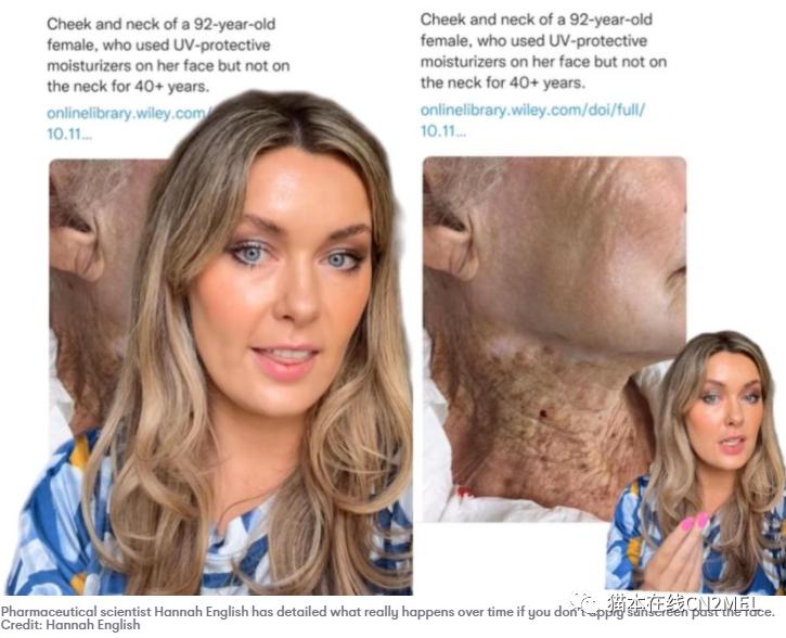 在脖颈涂防晒霜需注意！墨尔本这名老奶奶的照片吓到我了