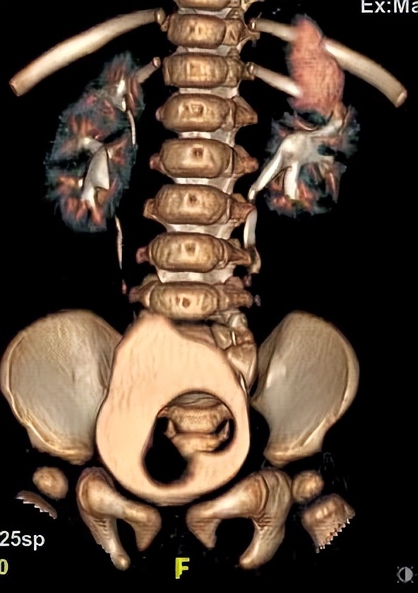重复肾、重复输尿管是怎么回事？有哪些表现？需要手术吗？