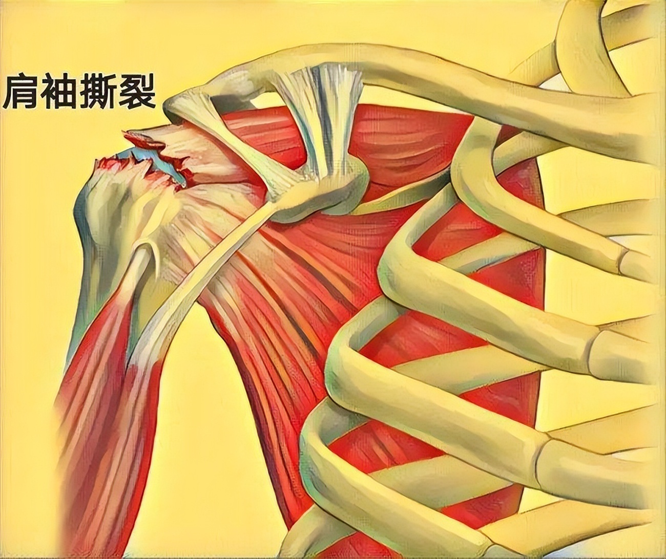 肩周炎最怕什么注意哪些,肩周炎欺软怕硬
