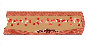 图解血管堵塞全过程，三氧疗法保持血管“年轻态”！