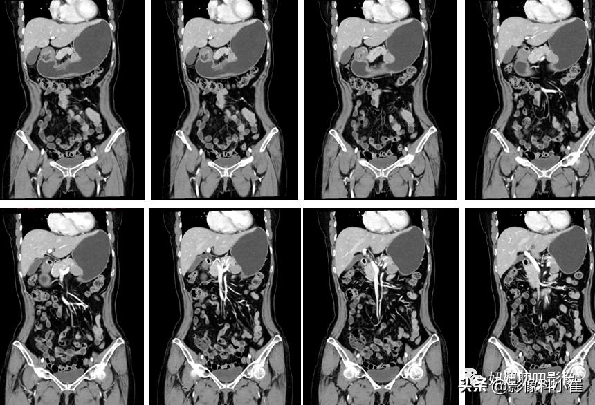 胃部肿瘤如果是恶性该怎么治疗,胃部肿瘤做什么能查出来