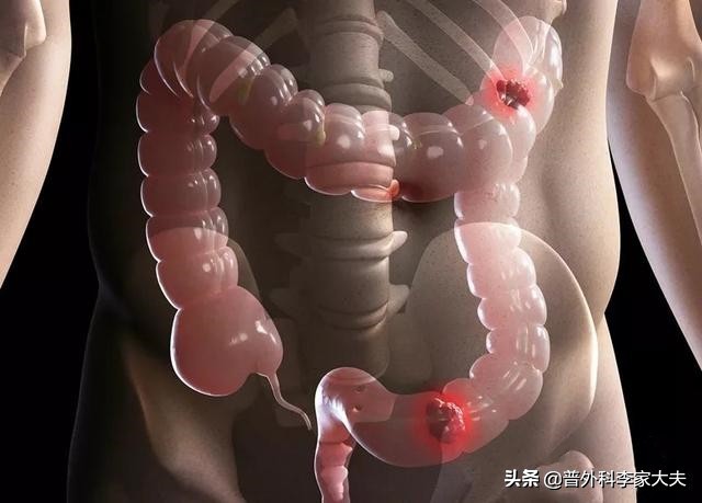 麦先生，我要对你说声抱歉，肠癌手术后让你辛苦了