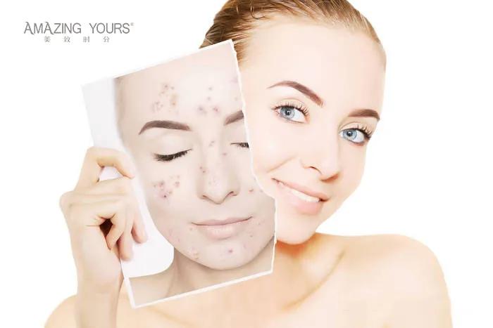 脸上长痘痘喝什么茶可以调理,内分泌失调怎么调理脸上长痘痘