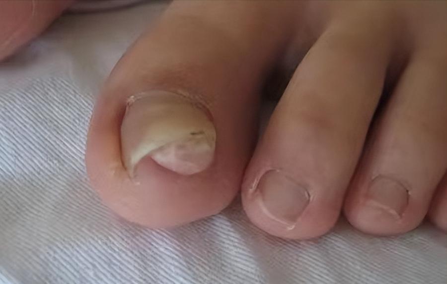 脚趾头一碰到就很疼怎么治,脚趾头走路疼捏着不疼是咋回事