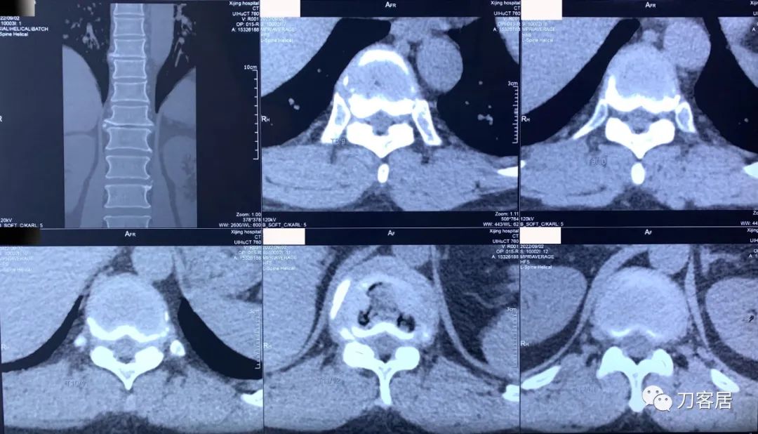 良性单侧下肢肌萎缩,下肢肌肉萎缩24年能治好吗