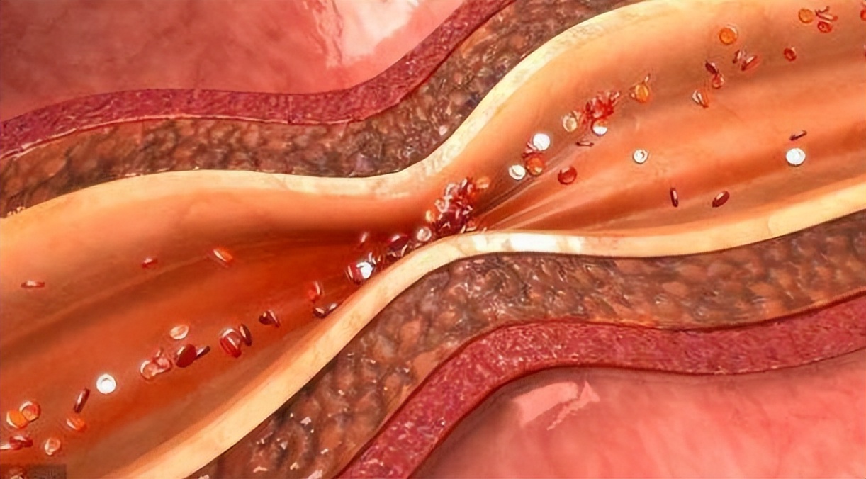 蹲久了站起来眼前发黑是低血糖,蹲一会眼前冒星星