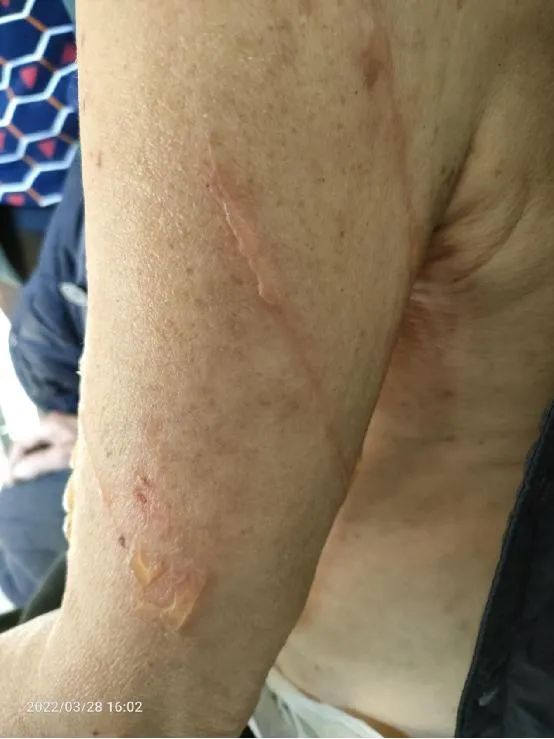 惊！一夜醒来胳膊上全是泡！二期皮肤压力性损伤该如何护理？