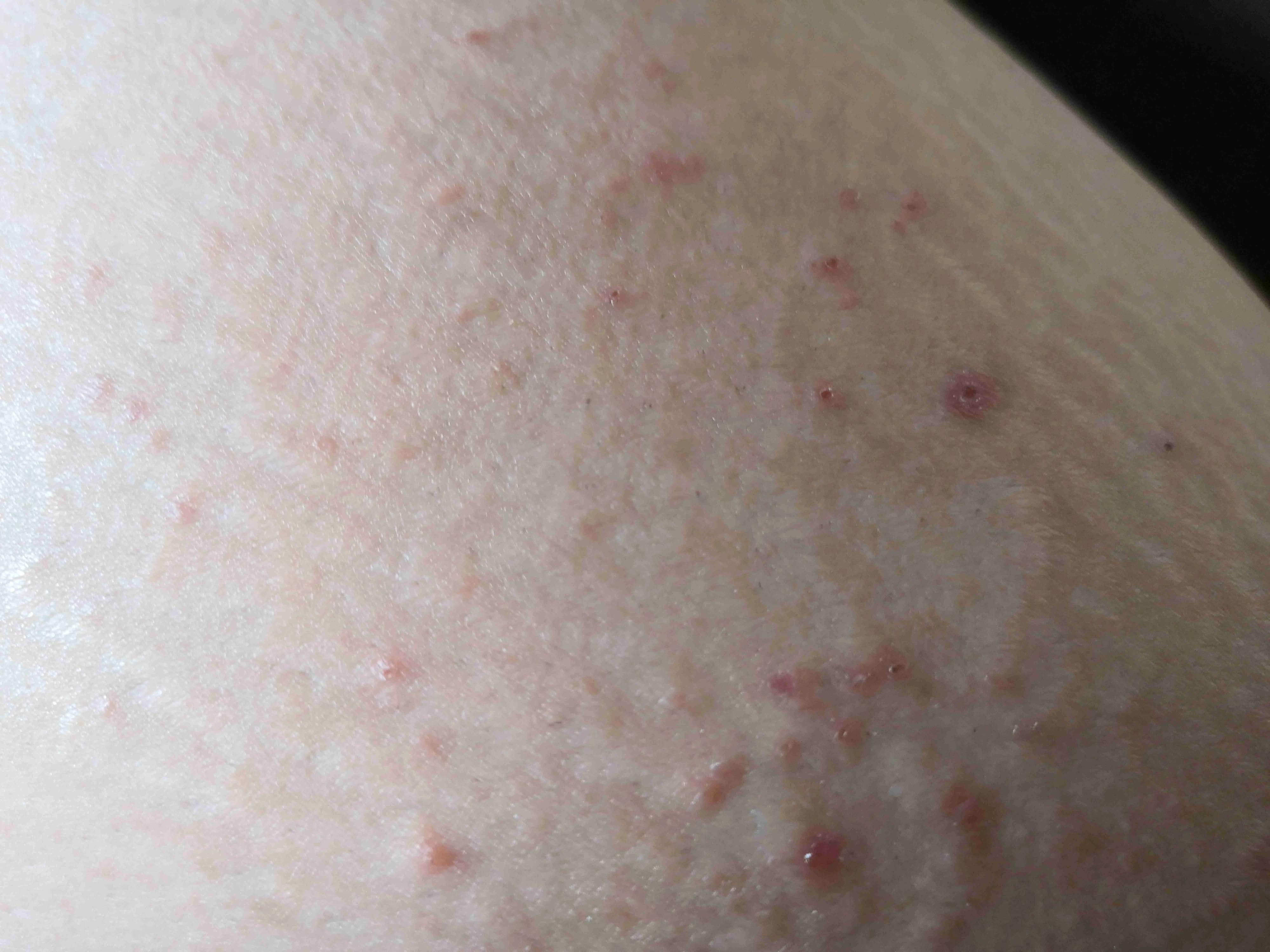 40岁做白内障手术选择什么晶体好,40岁做了白内障手术能维持多少年