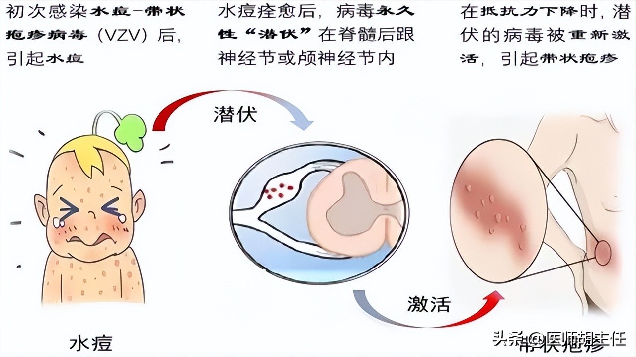 带状疱疹令人疼痛难忍该如何预防,哪些是带状疱疹患者要纠正的误区