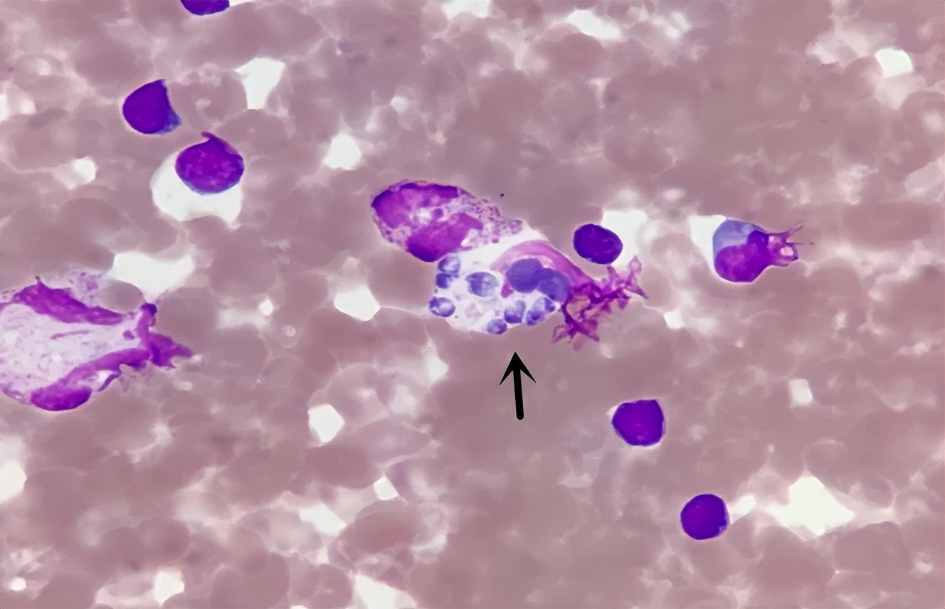 女子胸痛去医院检查出癌症,胸痛医生怀疑是肺癌