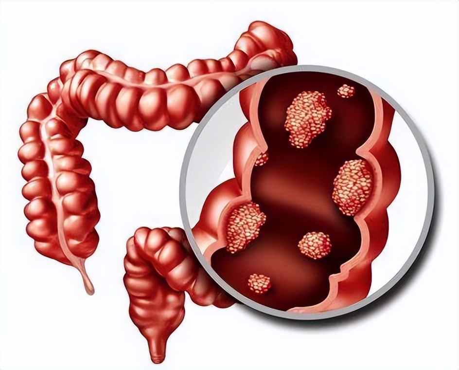 结直肠癌遗传几率高吗,结直肠癌有遗传吗
