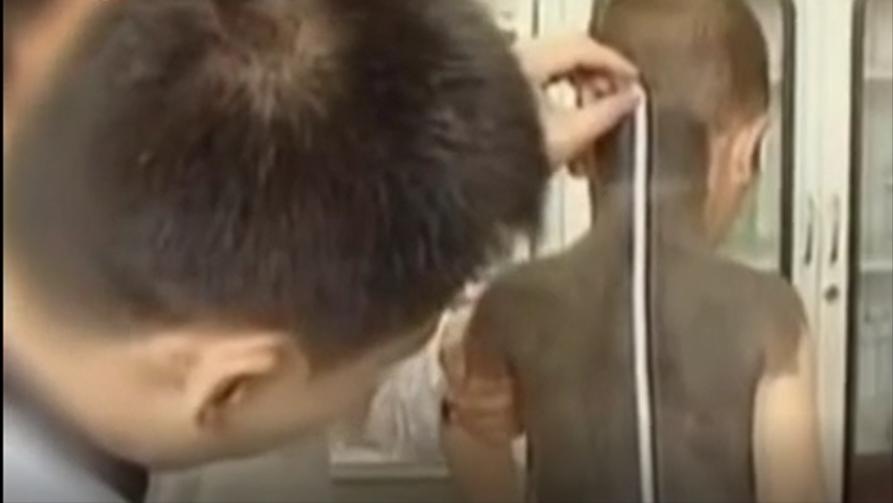 割皮救子父亲康复情况,儿子刚出生为弟弟捐骨髓后续