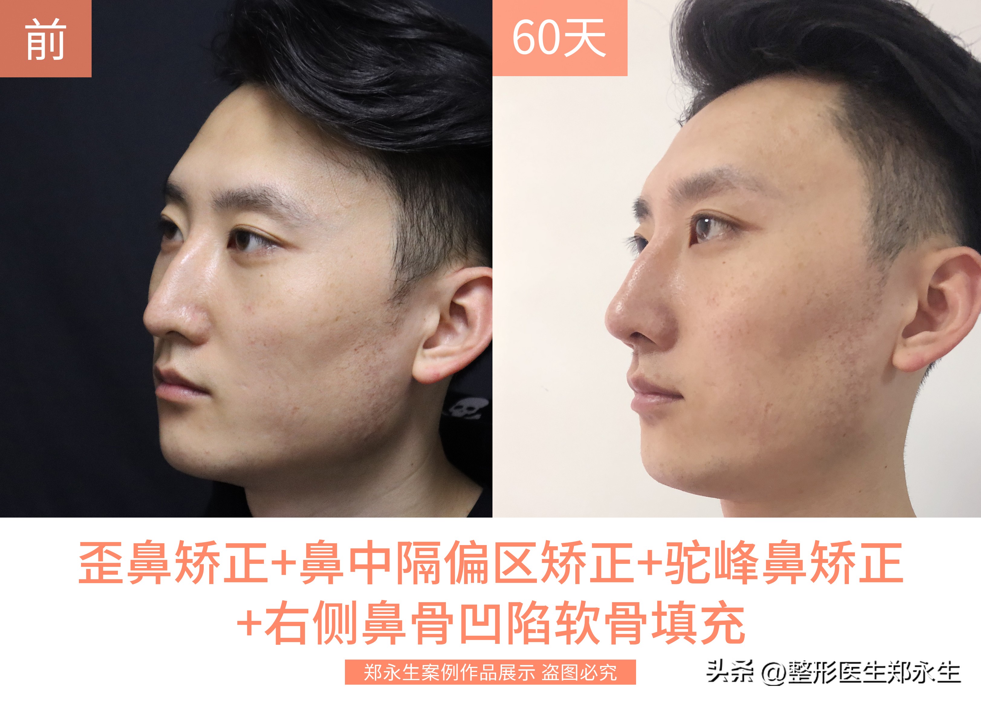 歪鼻子如何整形,歪鼻手术案例男