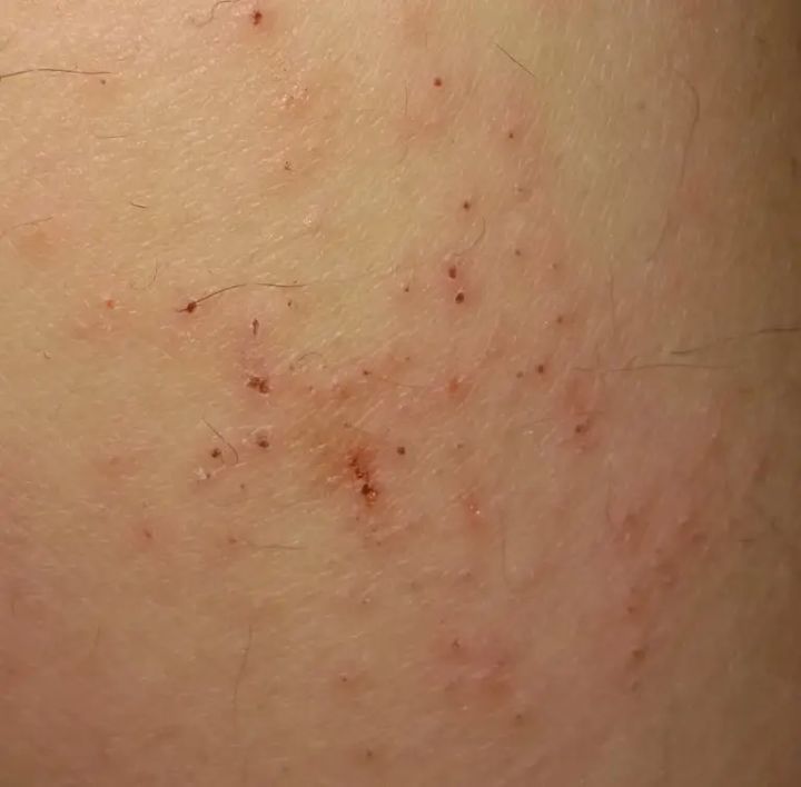 洗完澡身上痒还起皮是怎么回事,洗完澡皮肤干燥起皮浑身痒