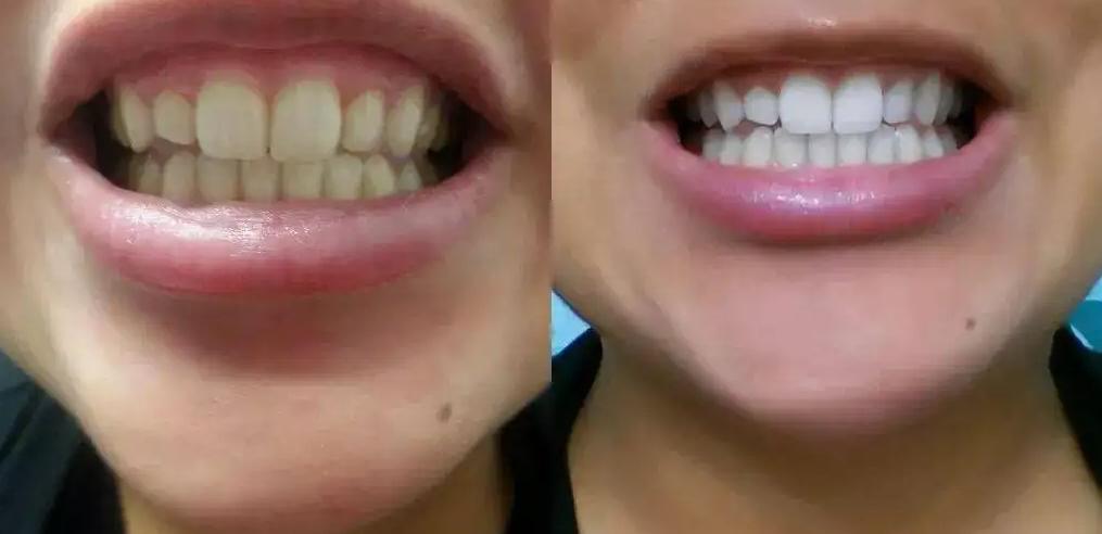 牙缝有牙垢怎么去除,牙缝牙垢又臭又硬怎么去除