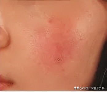 面部有紫色血丝的原因,老年人面部有血丝