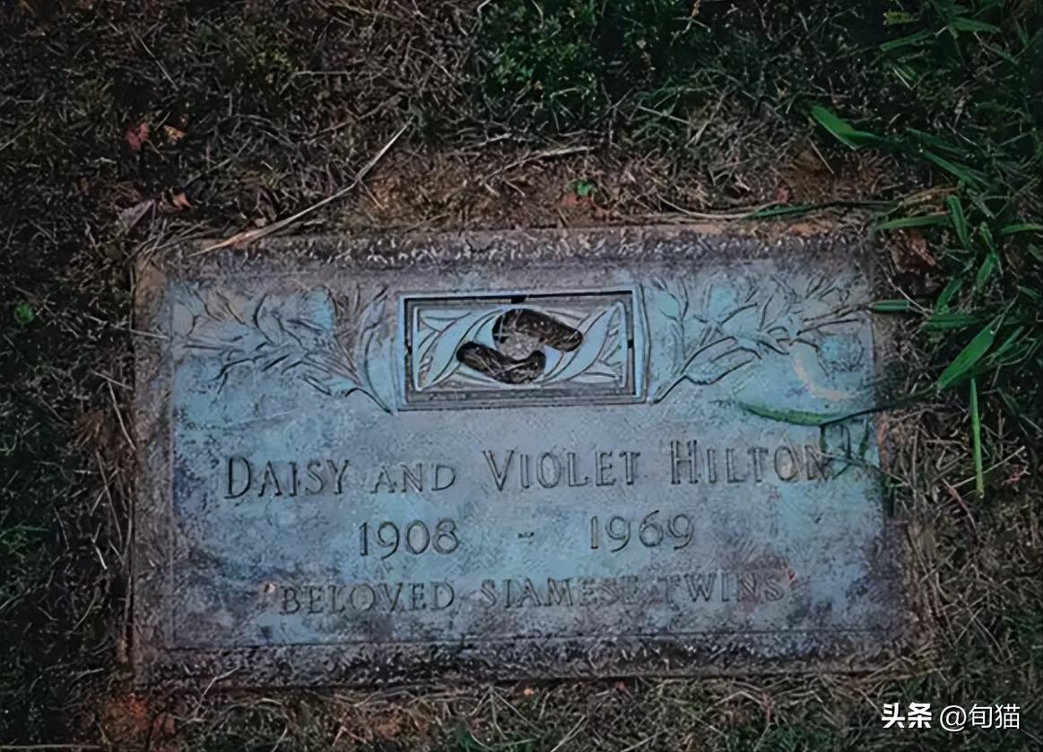 连体姐姐死亡原因,姐妹连体手术分离姐姐去世