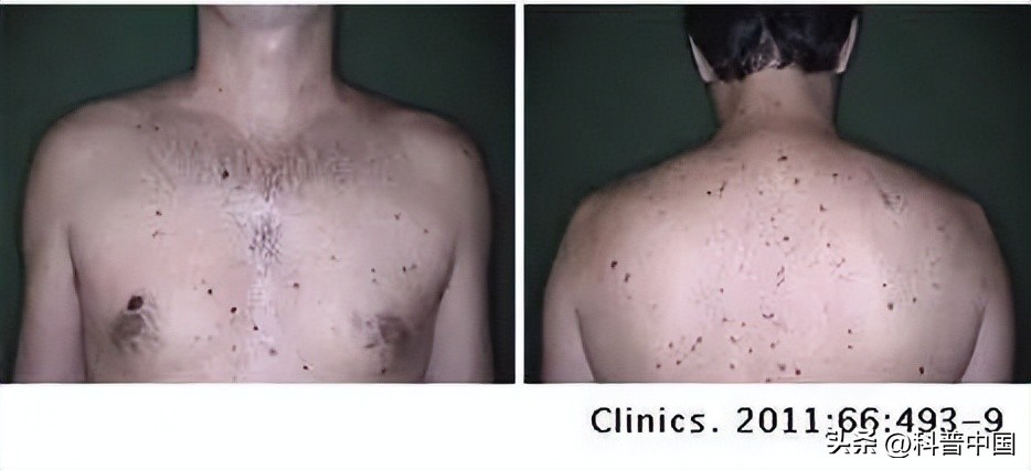 怎么判断身上的痣变癌,痣的病变到癌需要多长时间