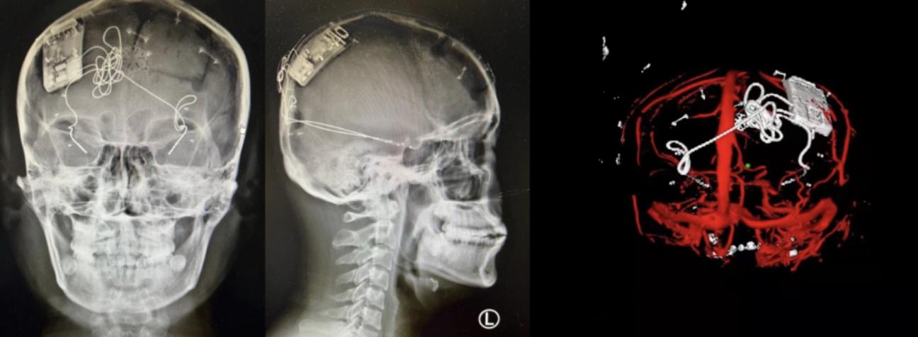 脑内植入ai芯片,脑中植入芯片治疗抑郁症