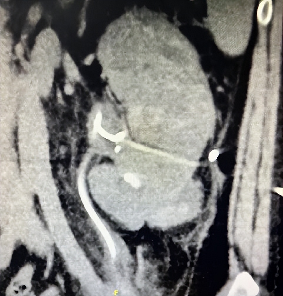 哈医大一院门诊极速抢救,医院多学科成功抢救失血性休克