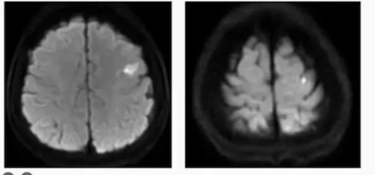 缺血性卒中治疗原则,缺血性卒中病因分型