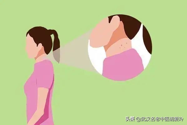 脖子和身上起红包很痒怎么办