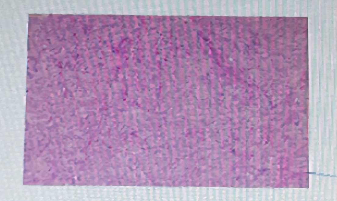 脑膜瘤头疼吃什么中药,脑膜瘤头疼怎么办